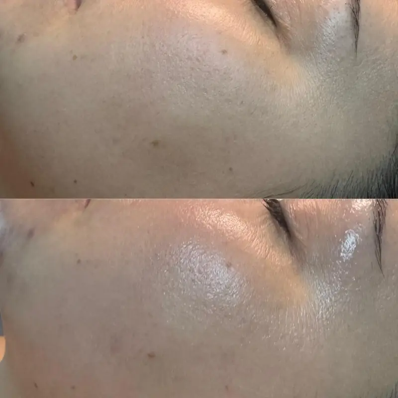 Peel Season: Why Autumn Is When Chemical Peels Actually Work Best